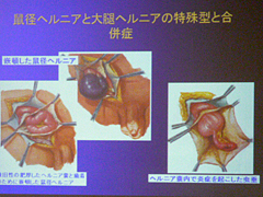 2009年9月公開医学講座の様子 鼠径ヘルニアの手術について