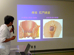 2009年9月公開医学講座の様子 痔の手術について